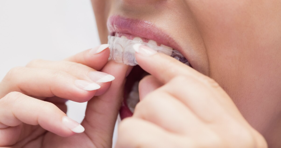 What Are The Benefits of Invisalign?